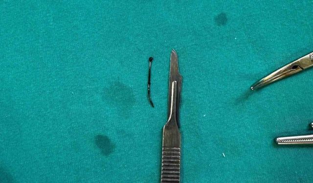 5 yaşındaki çocuğun yuttuğu toplu iğne ameliyatla çıkarıldı